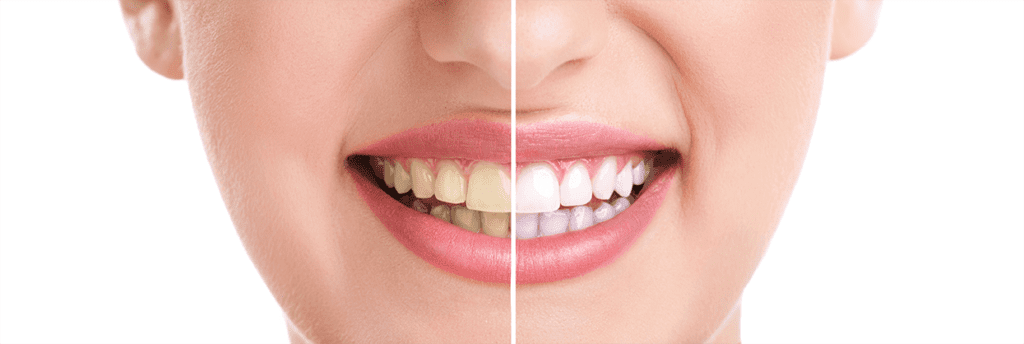 Teeth Whitening Clinic Near Me